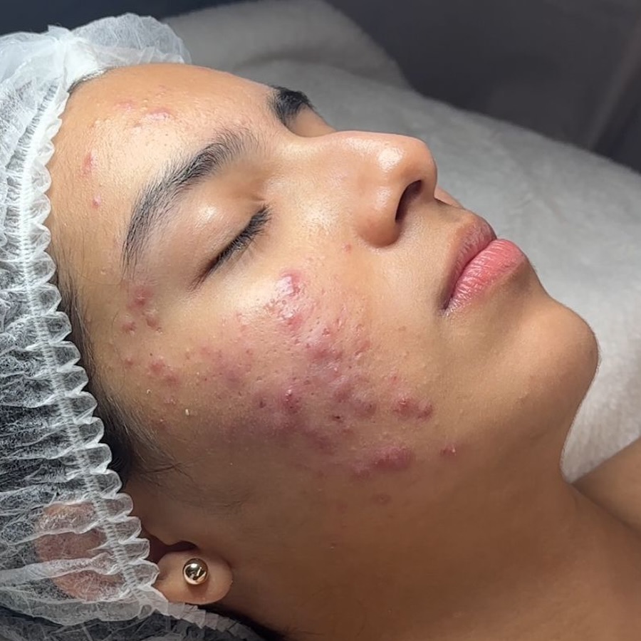 Valentina antes del tratamiento anti-acné